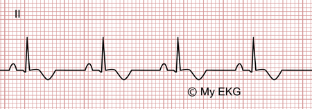 pericarditis-aguda-fase3.png